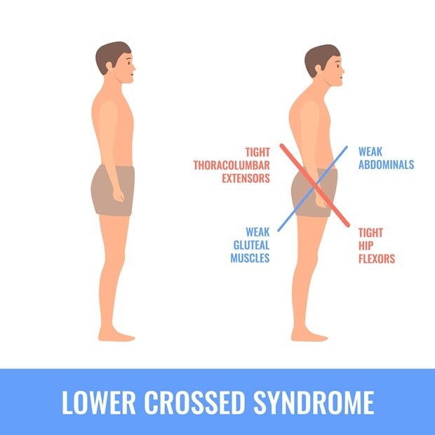 Lower Crossed Syndrome