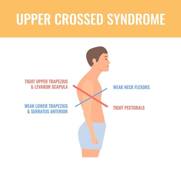 Uppper Crossed Syndrome